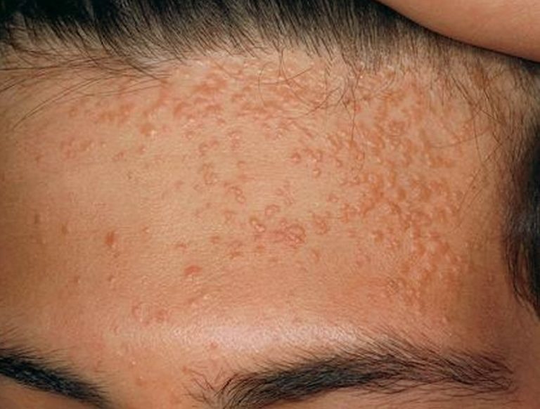 Flat Warts (Verruca plana) Fast Wart Remover